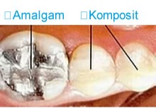 Amalgam - Komposit