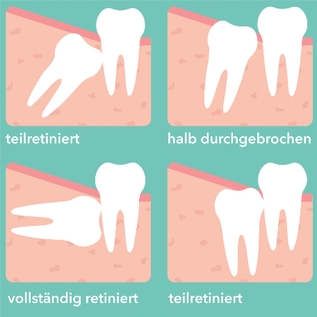 Teilretiniert oder vollständig retinierter Weisheitszahn